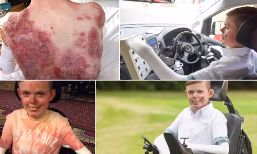 Cậu bé quấn băng 4h/ngày vì mắc bệnh da hiếm gặp