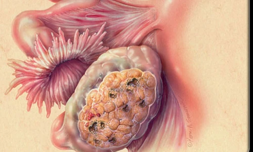 Sự thật khiến bạn ngỡ ngàng về ung thư