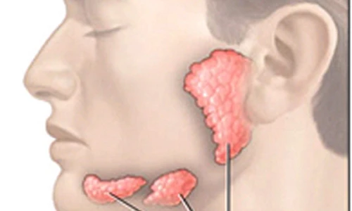 Dấu hiệu thường gặp của ung thư tuyến nước bọt