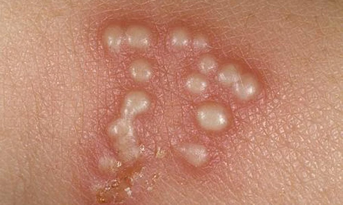 Bí kíp phòng mụn cóc sinh dục nam giới cực đỉnh