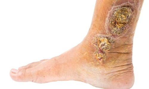 Dấu hiệu bệnh tật qua sự thay đổi của bàn chân