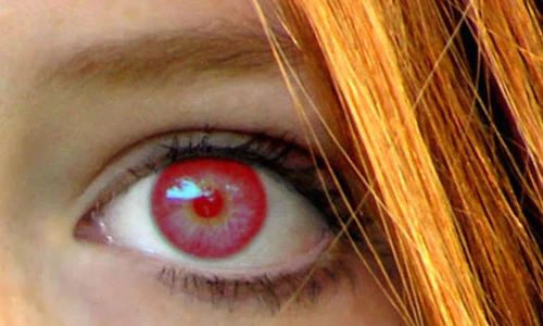 Những dấu hiệu nguy hiểm chết người trên đôi mắt