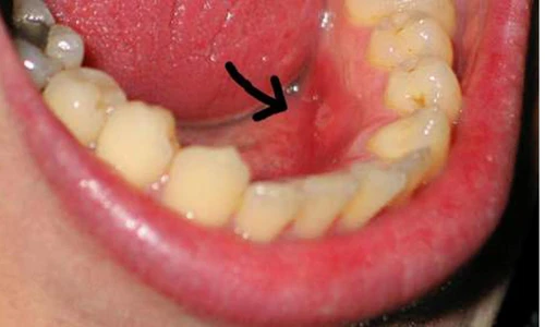 Dấu hiệu nhận biết ung thư miệng