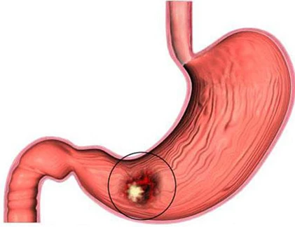 Nguyên nhân khiến bạn dễ mắc ung thư dạ dày