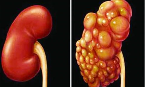 Cách dễ dàng ngăn ngừa ung thư thận