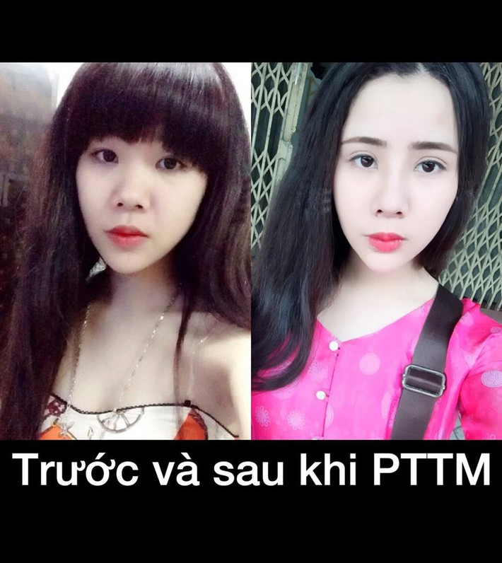 Tạ Mai Anh (sinh năm 1994, đang làm nghề kinh doanh ở Hà Nội) là cô gái có câu chuyện làm đẹp, những kinh nghiệm xương máu về việc làm phẫu thuật thẩm mỹ, cải thiện nhan sắc. 9X Hà thành từng khổ sở chịu đựng hậu quả khi quá vội vàng làm đẹp mà không cân nhắc kỹ càng.