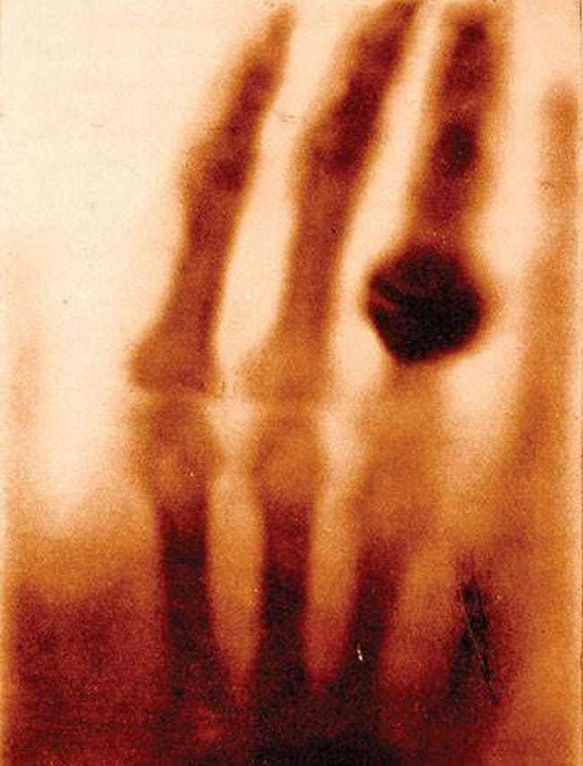 Một trong những bức ảnh X-quang đầu tiên được ghi lại vào ngày 22/12/1895.