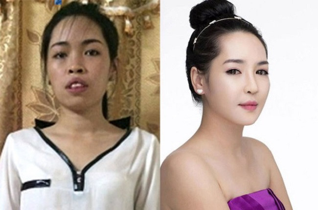 Tiếp theo là cô gái đến từ Nam Định, tên Vũ Thanh Quỳnh (sinh năm 1992). Quỳnh "lột xác" hoàn toàn nhờ phẫu thuật thẩm mỹ.