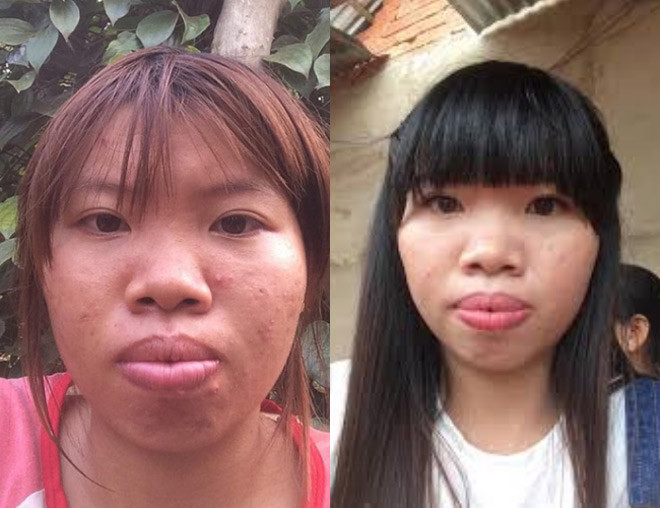 Chi hàng trăm triệu cải thiện nhan sắc, xóa bỏ hoàn toàn diện mạo cũ với làn da đen nhẻm đầy mụt nhọt, đôi gò má cao sóng đôi, chiếc mũi thô kệch, hàm răng hô, đôi môi dày… Quách Kim Phượng – người tự nhận mình là “ Phượng Thị Nở” đã có một cuộc đời mới. Không chỉ xinh đẹp hơn, cuộc sống sang chảnh hơn mà cô gái 22 tuổi đã tìm thấy tình yêu mới sau gần 2 năm sống đời lẻ bóng khi ly hôn chồng. Bến đỗ mới của Quách Phượng là một chàng trai tân 28 tuổi, “giản dị nhưng rất ấm áp". Cặp đôi quen nhau qua Zalo, rồi “bén lửa tình” chỉ sau 2 tháng gửi cho nhau tin nhắn đầu tiên.