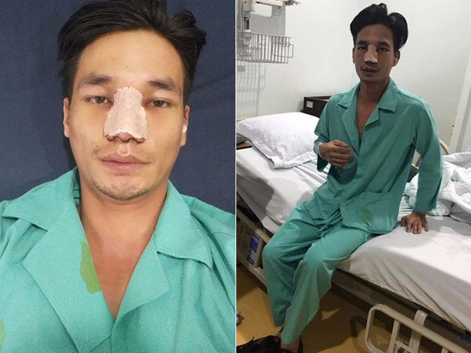 Thông tin Lệ Rơi (tên thật là Nguyễn Đức Hậu, sinh năm 1987, Hải Dương) phẫu thuật thẩm mỹ từng “gây sóng” cộng đồng mạng cuối tháng 7 vừa qua. Sau khi nâng sụn mũi, cắt gọn cánh mũi, bóc tách phần mỡ thừa ở mắt, “hot boy vườn ổi” mang diện mạo hoàn toàn mới. Tuy nhiên, diện mạo ấy cũng nhận được nhiều ý kiến trái chiều. Một số người cho rằng, anh đã “lột xác” thành công với gương mặt lai Tây nhưng cũng không ít người nhận xét, Lệ Rơi đã đánh mất vẻ chân chất ban đầu.