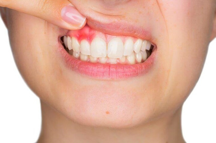 Nướu bị sưng tấy là hậu quả của viêm: Vitamin C giúp ngăn ngừa như một chất chống oxy hoá. Việc bổ sung vitamin C thích hợp đã được chứng minh là có lợi trong việc cải thiện sức khoẻ của nướu răng và giảm viêm lợi.