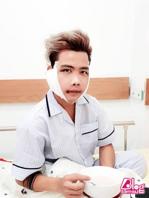 Và mới đây nhất, đích thân bác sĩ phẫu thuật thẩm mỹ cho Tùng Sơn đã chia sẻ lên mạng xã hội một đoạn video clip ngắn quay lại hình ảnh toàn bộ gương mặt Tùng Sơn sau khi thẩm mỹ xong vài ngày.