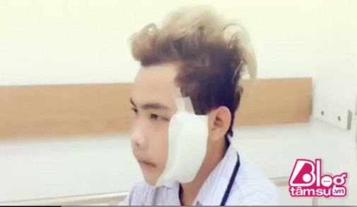 Có thể thấy mới chỉ thay đổi khung khuôn mặt và hàm răng thôi, thì mặc dù gương mặt của Tùng Sơn có đang bị sưng và phù thì cũng đã đẹp trai hơn trước đây khá nhiều. Hiện tại anh chàng đang trong thời gian tĩnh dưỡng, đã có thể ăn cháo loãng và đang trong thời gian chờ đợi những ca phẫu thuật tiếp theo.