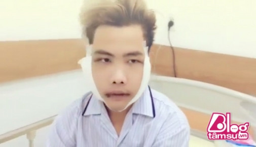 Theo đó, đây là bức ảnh của Tùng Sơn sau 3 ngày phẫu thuật thẩm mỹ thay đổi toàn diện gương mặt trước đây. Bác sĩ đã giúp Tùng Sơn thay đổi khung xương hàm mặt bao gồm xương gò má, xương hàm trên – hàm dưới, góc hàm và xương cằm.