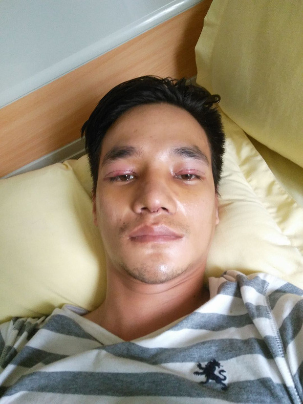 Chưa hài lòng với việc sửa mũi, "ca sĩ Lệ Rơi" còn tiến hành cắt mỡ thừa và nhấn mí mắt.