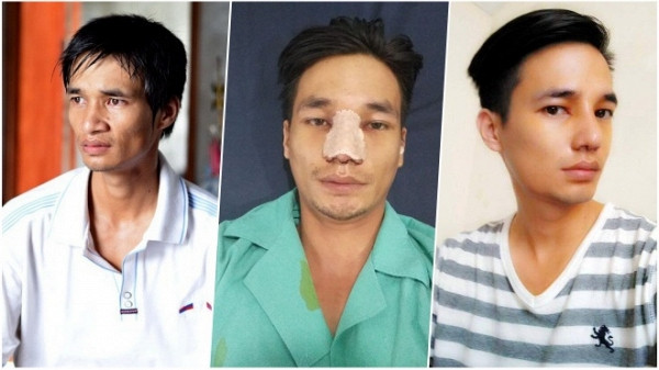 Lệ Rơi phẫu thuật thẩm mỹ và gặp phải những phản ứng trái chiều của cư dân mạng. Nhiều người cho rằng, chàng trai sinh năm 1987 đang bắt đầu giống "Công chúa thủy tề" Tùng Sơn phẫu thuật để tham gia showbiz. Bên cạnh đó, một số người cho rằng, Lệ Rơi đã điển trai hơn trước rất nhiều với vẻ đẹp lai tây.