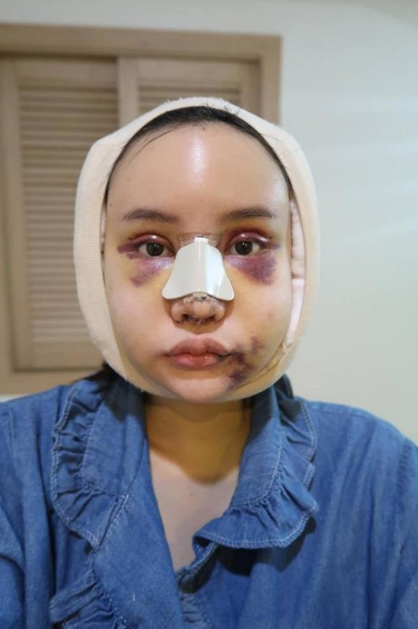 Sau ca phẫu thuật thẩm mỹ, gương mặt của Piyapeauty xưng phù nề và biến dạng. Cô không thể mở mắt hay ăn uống được.