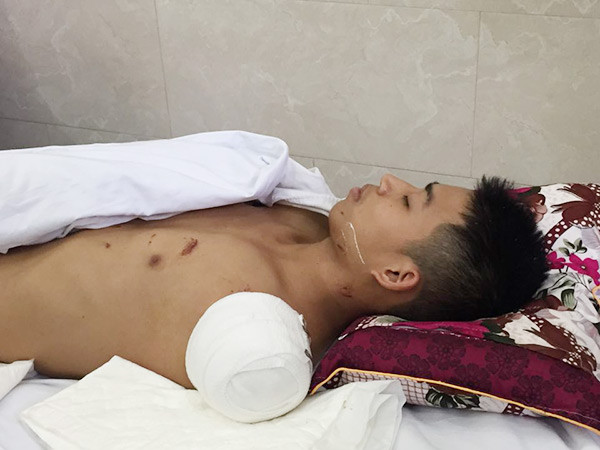 Sau vụ tai nạn, cả Huy và Quân được đưa đến khoa Chấn thương chỉnh hình, bệnh viện Việt Đức để phẫu thuật, cứu chữa. Khi Huy tỉnh lại, đã có rất nhiều người đến thăm hỏi và cập nhật tình hình sức của khỏe của cậu. Trên mạng, suốt những ngày qua tràn ngập những dòng chia sẻ thể hiện sự cảm kích của các bạn trẻ trước tấm lòng, sự hy sinh đáng trân trọng của Huy. Bản thân Huy cũng đã có một vài chia sẻ về hành động của mình trong một đoạn clip ngắn được chia sẻ công khai trên mạng xã hội. Ảnh: Dân Việt.