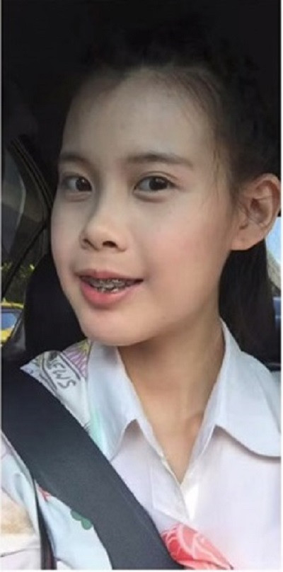 Cằm của cô gái cũng thon gọn hơn trước rất nhiều, giúp tổng thể khuôn mặt trông cân đối và "bình thường" trở lại.
