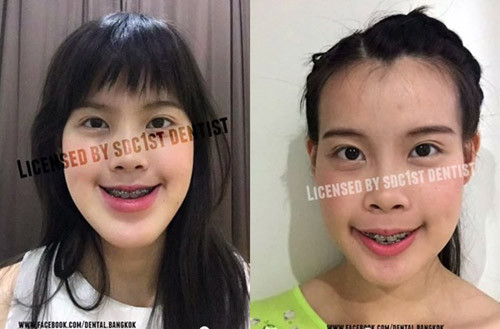 Với công nghệ phẫu thuật thẩm mỹ đỉnh cao từ Hàn Quốc và Thái Lan... phần hàm dưới của cô gái trẻ được thu gọn lại, rút ngắn dần khoảng cách nhô ra so với hàm trên.