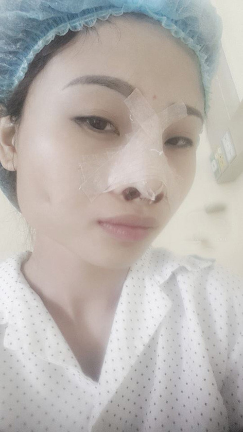 Từng bị nhận xét là "xấu hệt Thị Nở" nhưng Chippy Polla dường như chưa từng cảm thấy thấy buồn bã vì điều này. Cô gái trẻ luôn tự tin, thích cười nói và không ngại làm những clip, hình ảnh khoe mặt xấu để dân mạng có thể nhìn vào đó mà thỏa thích cười đùa. Mới đây, Chippy Polla lại tiếp tục gây ngạc nhiên khi quyết định làm phẫu thuật thẩm mỹ, "trùng tu" lại nhan sắc.