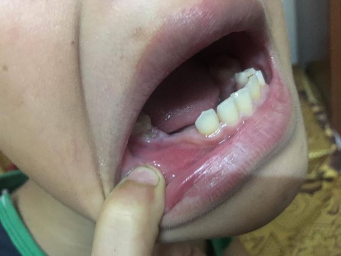 Thậm chí cháu N. còn "tố" bị bố đẻ đánh gãy răng. Hiện cơ quan chức năng đang làm rõ sự việc.