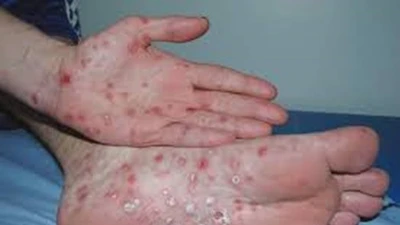Bệnh giang mai có thể chữa khỏi không?