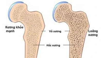 Nguyên nhân khiến nhiều người trẻ mắc bệnh loãng xương