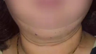 Cơ thể người phụ nữ “biến dạng” do lạm dụng thuốc corticoid