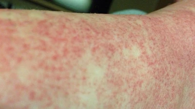 Cô gái trẻ suýt mất mạng vì sốc sốt xuất huyết Dengue