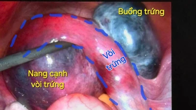 Hai ca xoắn cơ quan sinh dục nguy hiểm được cấp cứu kịp thời