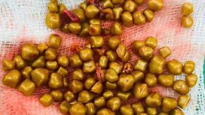 Gắp hơn 100 viên sỏi từ túi mật của nữ bệnh nhân 54 tuổi