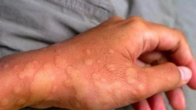 Nguyên nhân nổi mề đay, cách phòng tránh