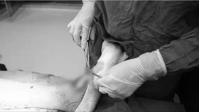 Chủ quan vết xước nhỏ, người đàn ông bị áp xe, nhiễm khuẩn huyết 