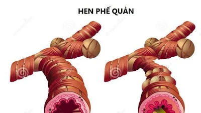 Nhầm lẫn giữa bệnh hen và phổi tắc nghẽn nguy hiểm thế nào?