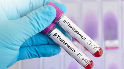 Phát hiện trẻ 19 tháng tuổi mang đột biến gene Thalassemia