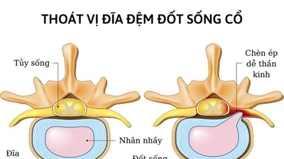 Thay nhân đĩa đệm nhân tạo giúp nam thanh niên thoát nguy cơ liệt tứ chi