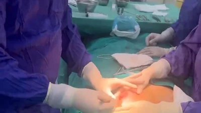 Ngực biến dạng, chảy mủ vì tiêm chất làm đầy từ 5 năm trước