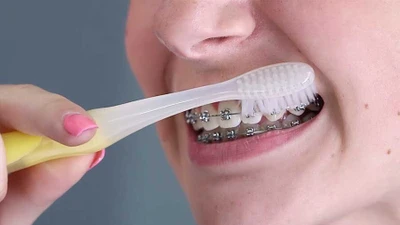 Biến chứng nghiêm trọng sau quá trình niềng răng kéo dài