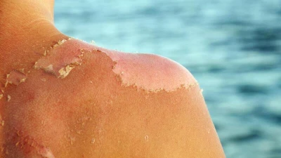 Cách phục hồi da cháy nắng mùa hè hiệu quả