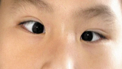 Chứng lác mắt ở trẻ tăng do sử dụng thiết bị điện tử
