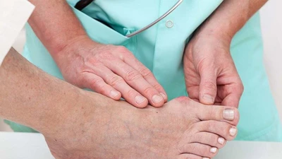 Bác sĩ cảnh báo tự ý dùng corticoid trị gout có thể gây tàn phế