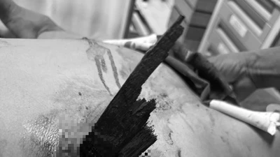 Cứu sống nam thanh niên bị gỗ đâm thấu ngực ở Quảng Bình