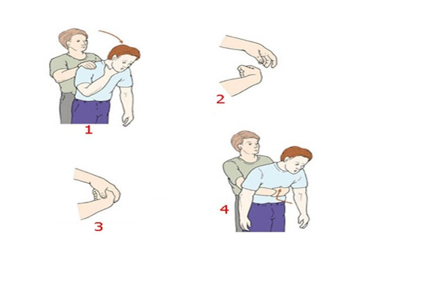 Nghiệm pháp Heimlich cần được sử dụng khi tắc nghẽn đường thở nặng và đe dọa tính mạng. so-cuu.jpg
