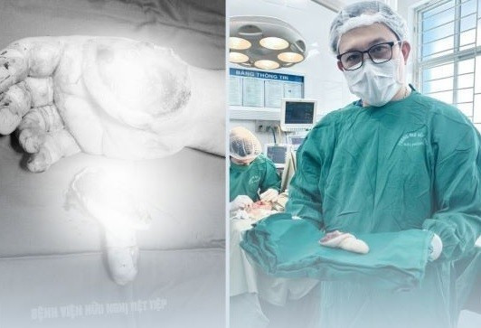 Ngón tay bị đứt rời của bệnh nhân - Ảnh BVCC noi-ngon-tay.jpg