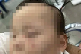 Cô giáo gây thương tích cho trẻ mầm non có thể bị xử lý thế nào? 