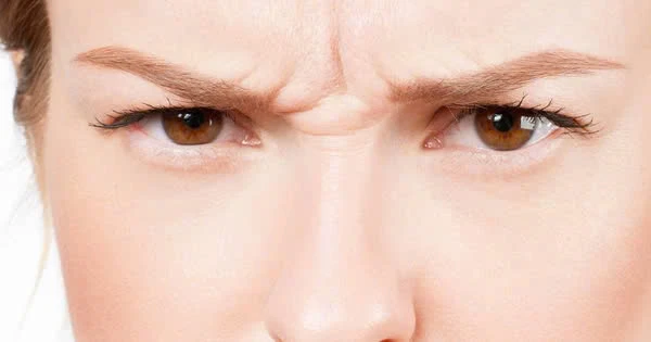 Tuyệt chiêu “xóa” nếp nhăn sống mũi