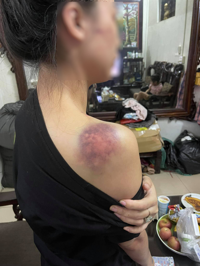 Cô vợ 9X tố chồng bạo hành bầm dập, netizen nhìn mà xót xa - Hình 2 Co vo 9X to chong bao hanh bam dap, netizen nhin ma xot xa-Hinh-2