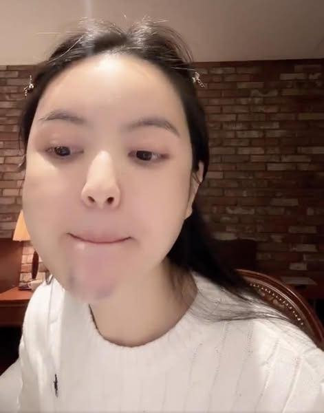 Cụ thể, hơn 2 năm trước, bà xã Quang Hải đã đi tiêm filler vào cằm. Theo cô nàng chia sẻ, chi phí cho việc phẫu thuật thẩm mỹ này khá đắt đỏ, tuy nhiên sau một thời gian, cô nàng quyết định đi tiêm tan.