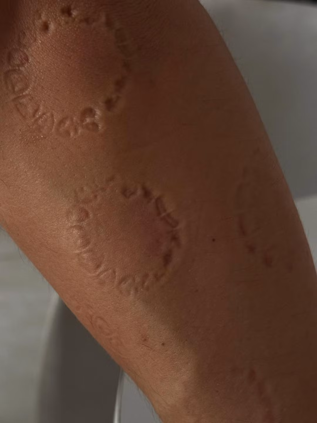 Võ Ngọc Trân cũng có cách thể hiện tình cảm vô cùng ấn tượng với bạn trai khi trên cánh tay anh chàng toàn là những vết cắn. (Ảnh: IGNV)